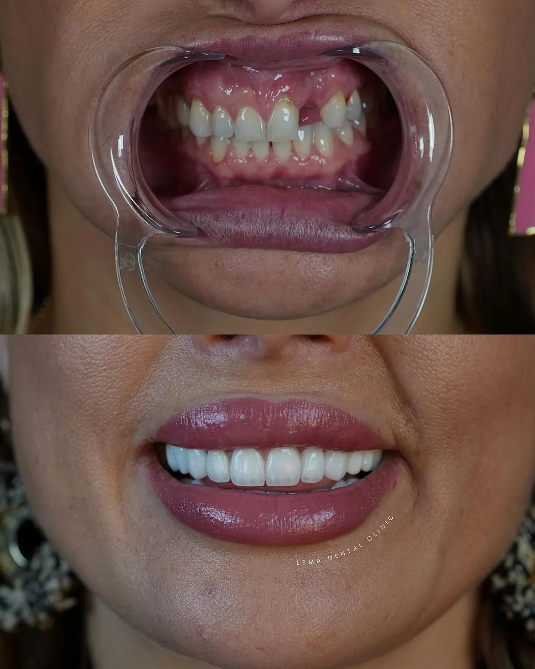 dental implants 1 dental clinic istanbul