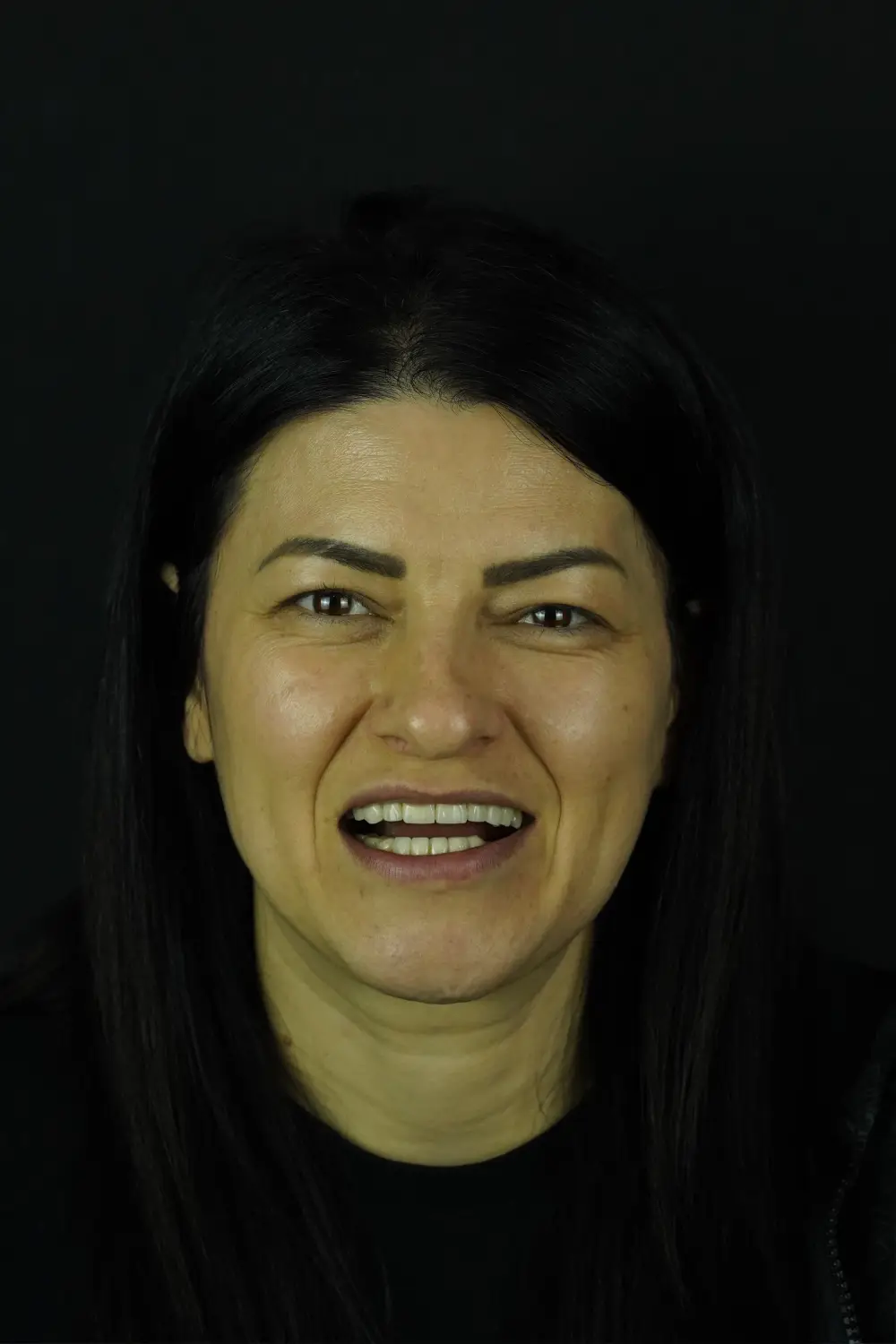 Smile design, upper and lower — Before