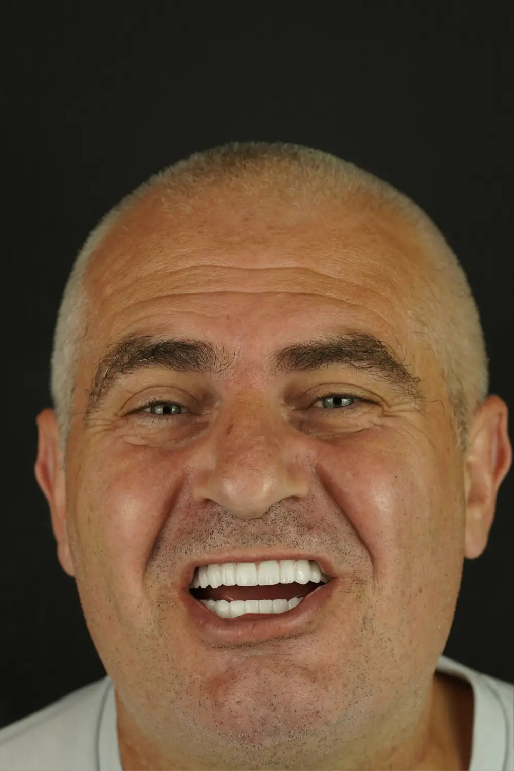 Full-arch implants, upper and lower — After