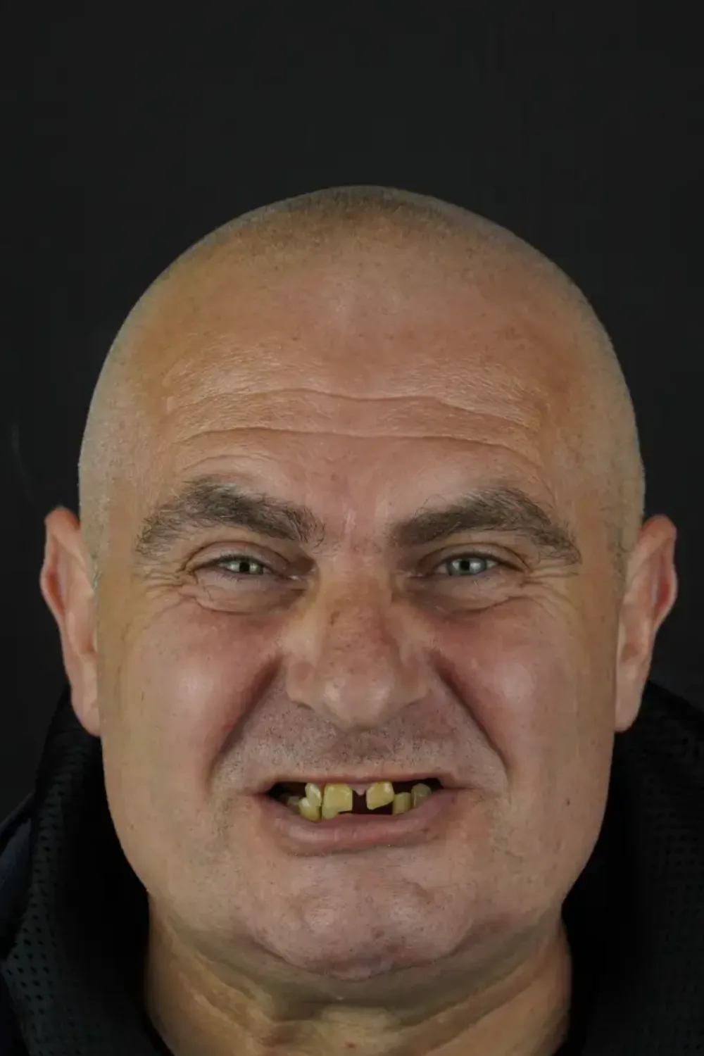 Full-arch implants, upper and lower — Before