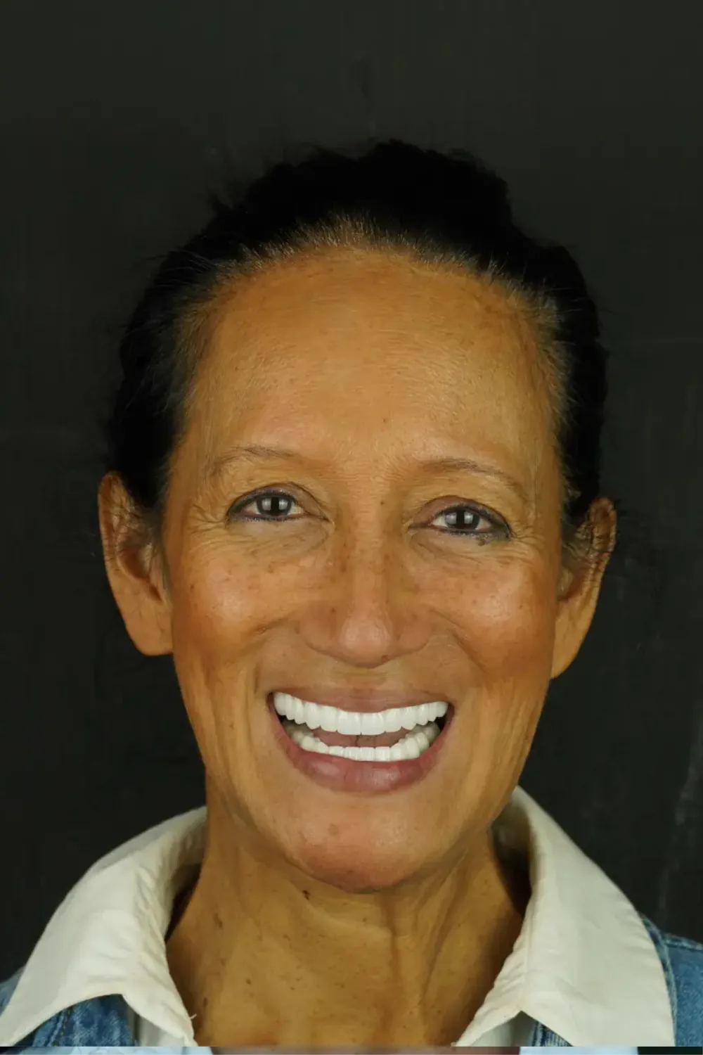 Smile design, upper and lower — After