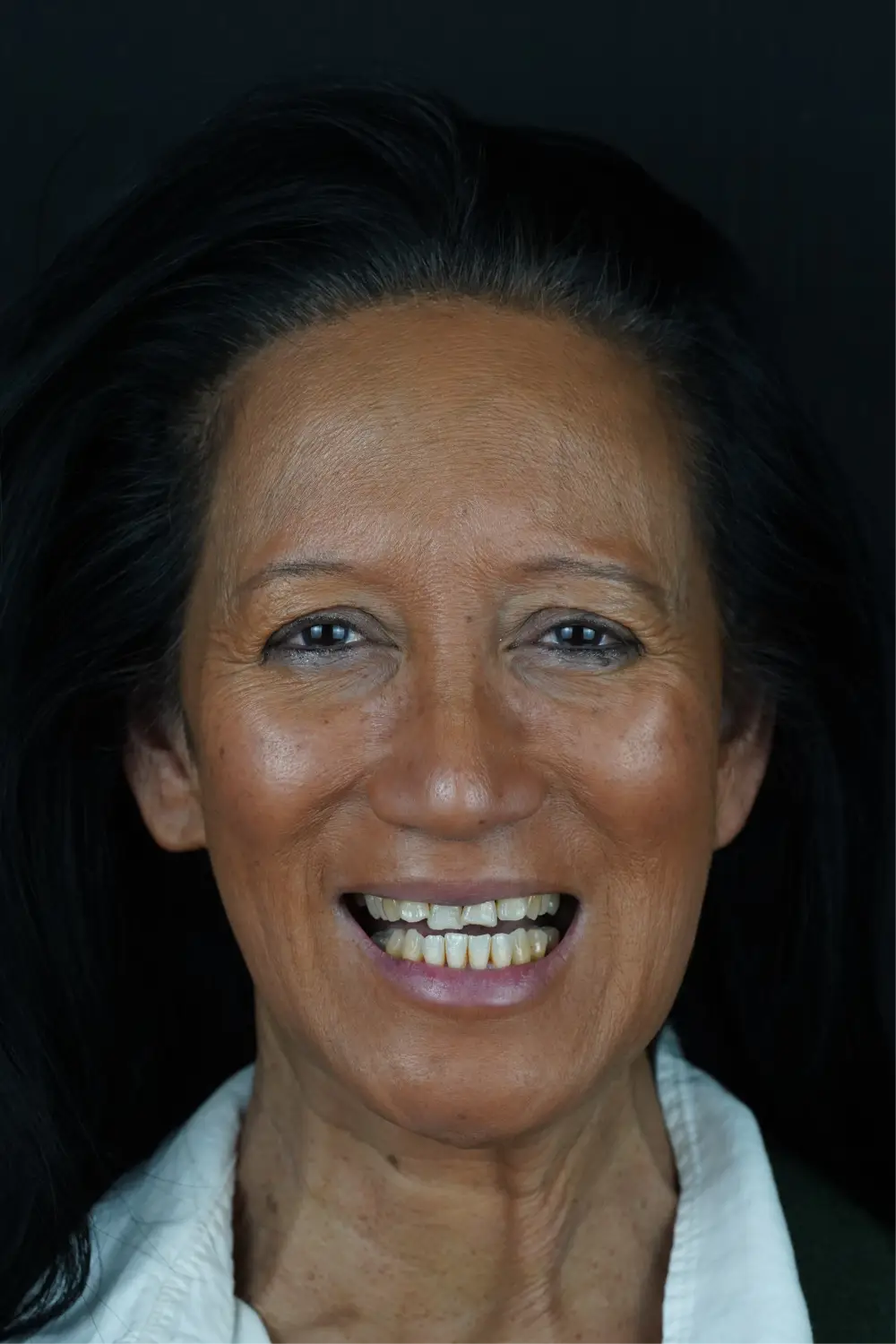 Smile design, upper and lower — Before