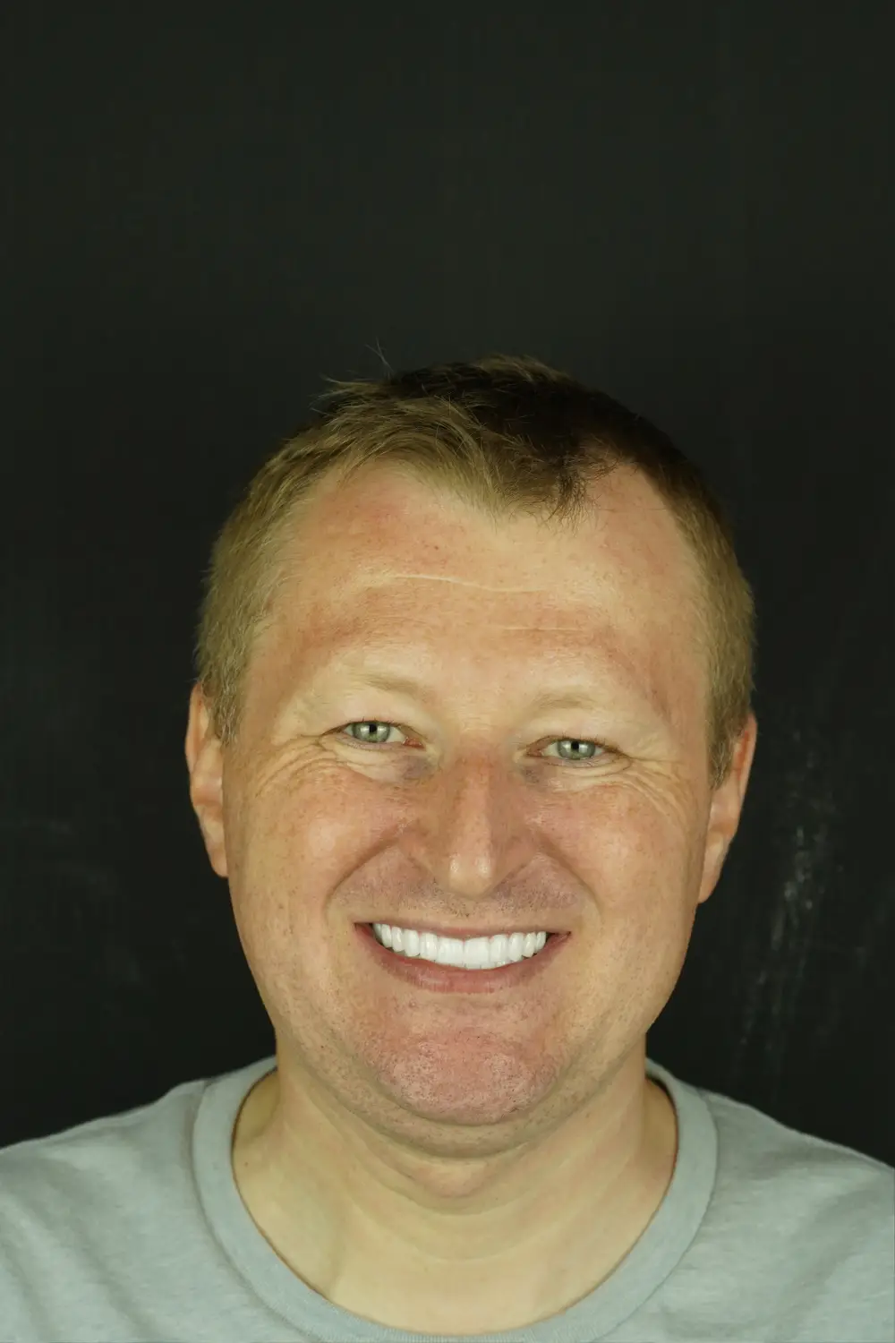 Full-arch implants, upper and lower — After