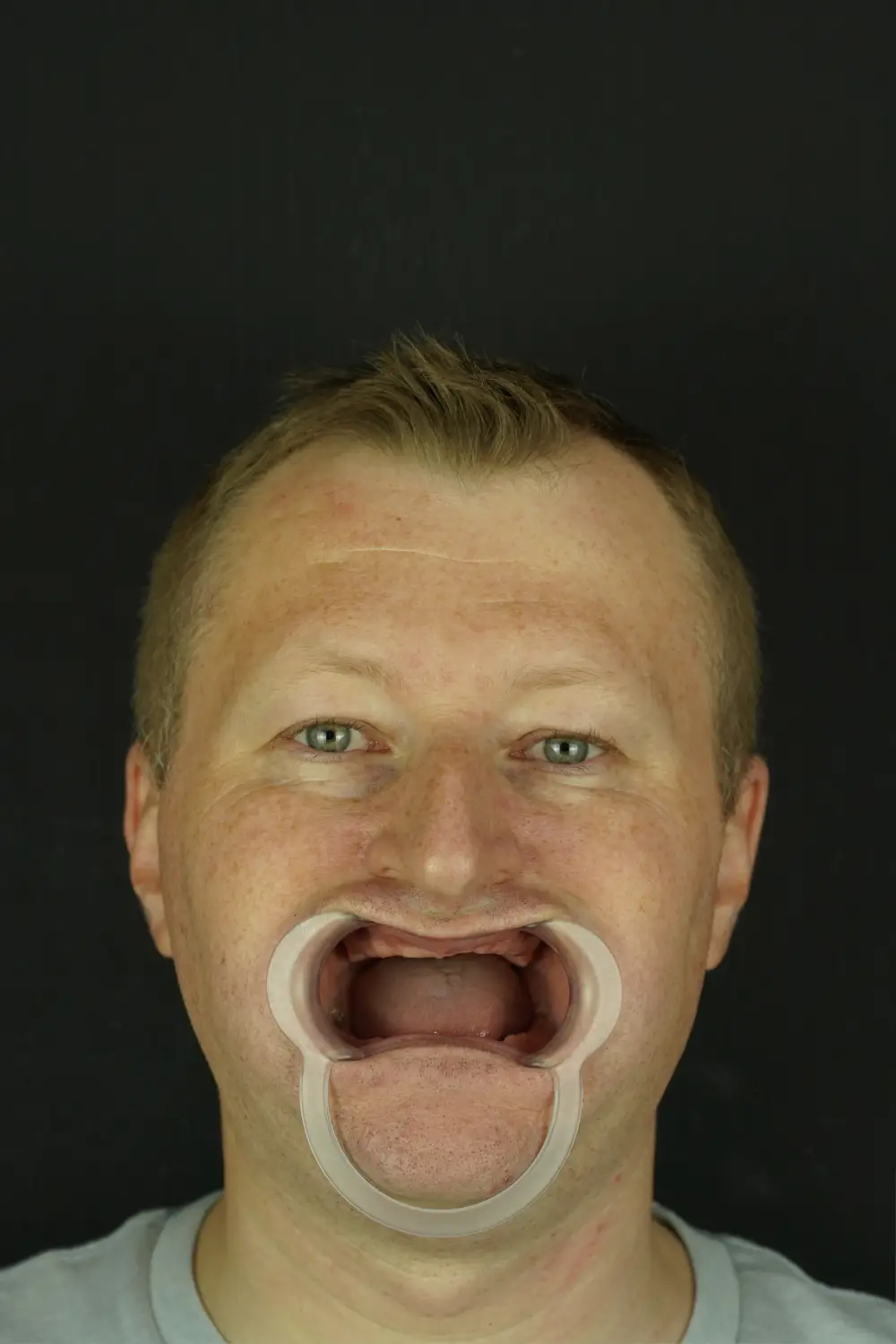 Full-arch implants, upper and lower — Before