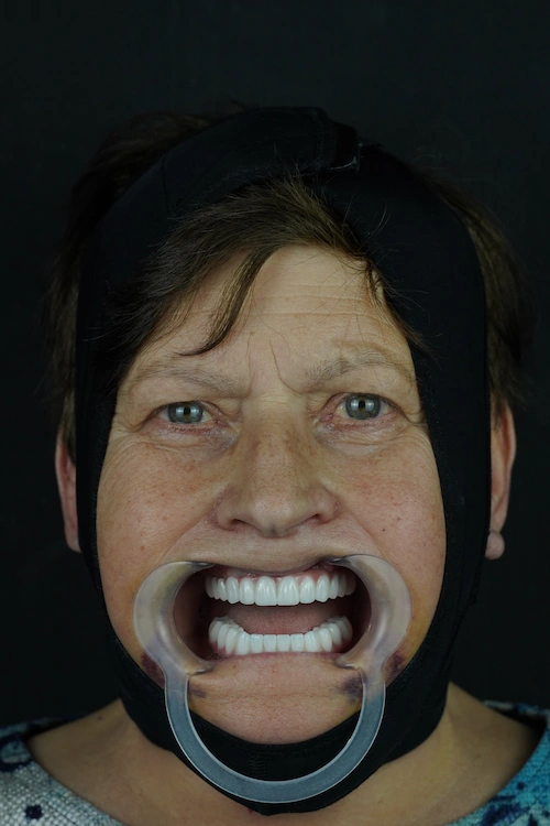 Full-arch implants, upper and lower — After