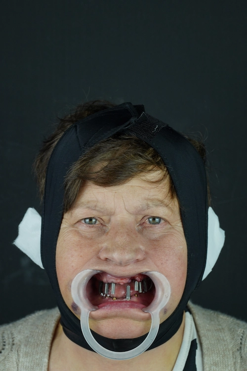 Full-arch implants, upper and lower — Before