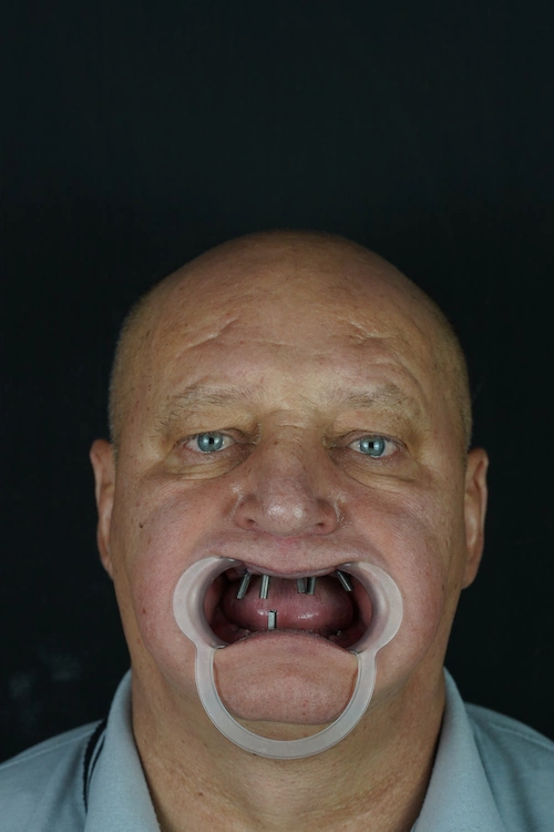 Full-arch implants, upper and lower — Before