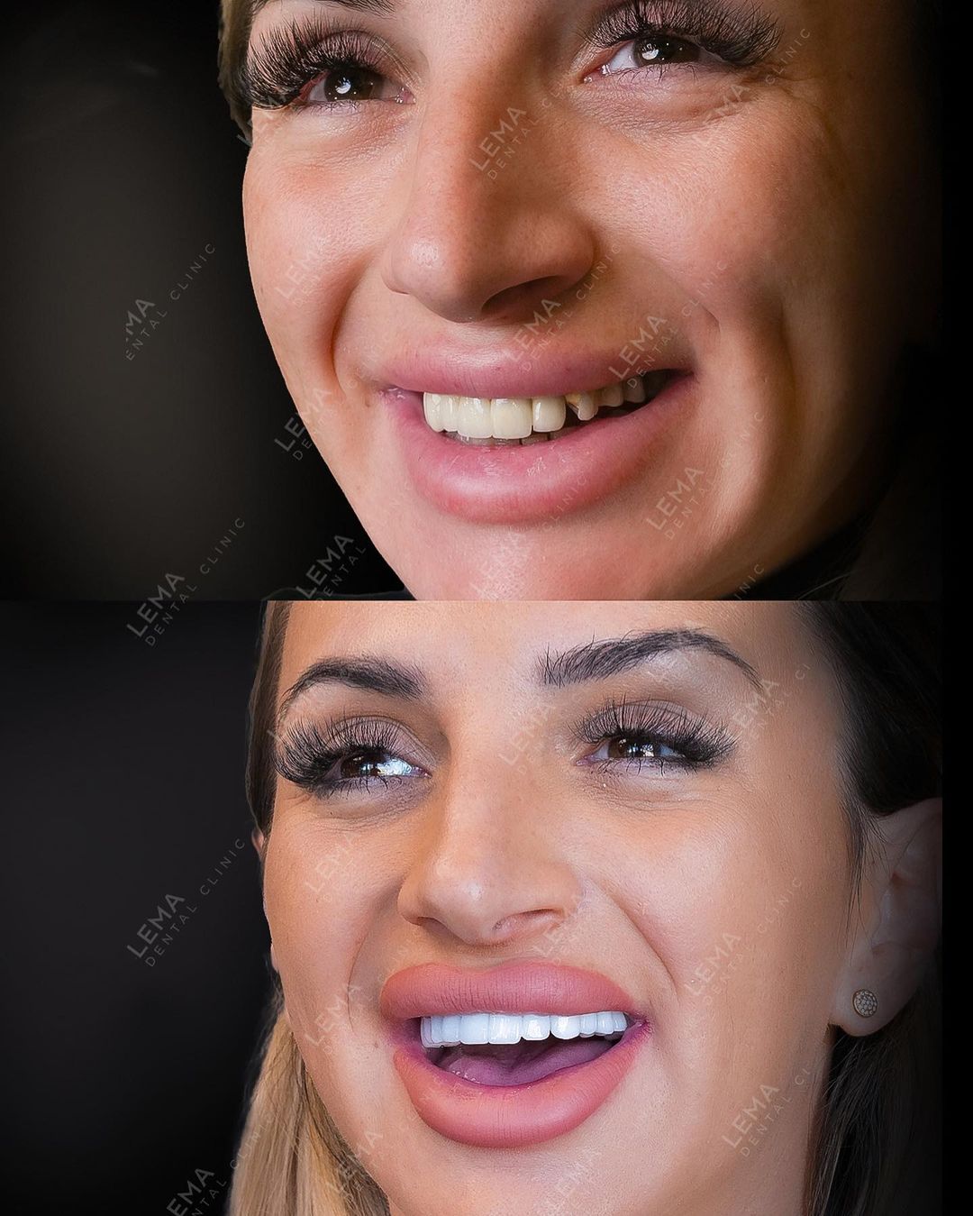 dental veneers