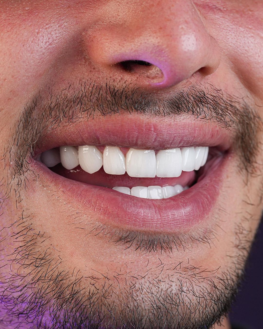 dental implant process