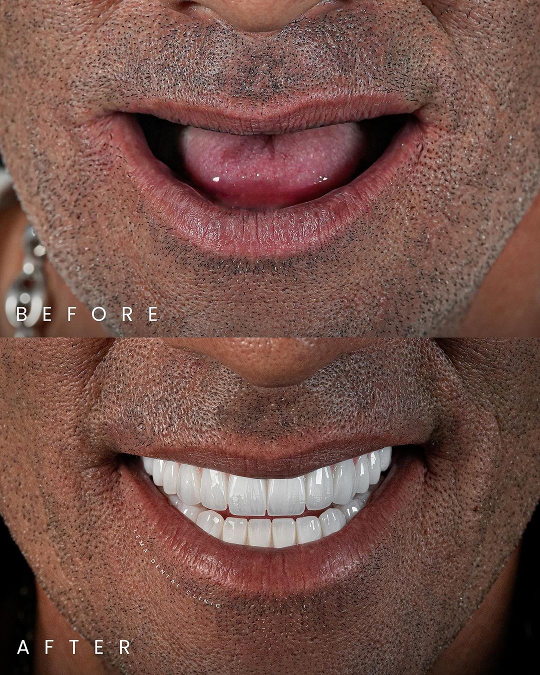 dental implant brand