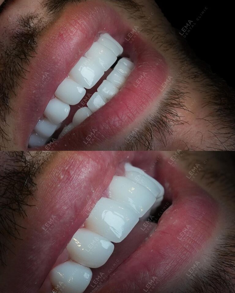 diş beyazlatma