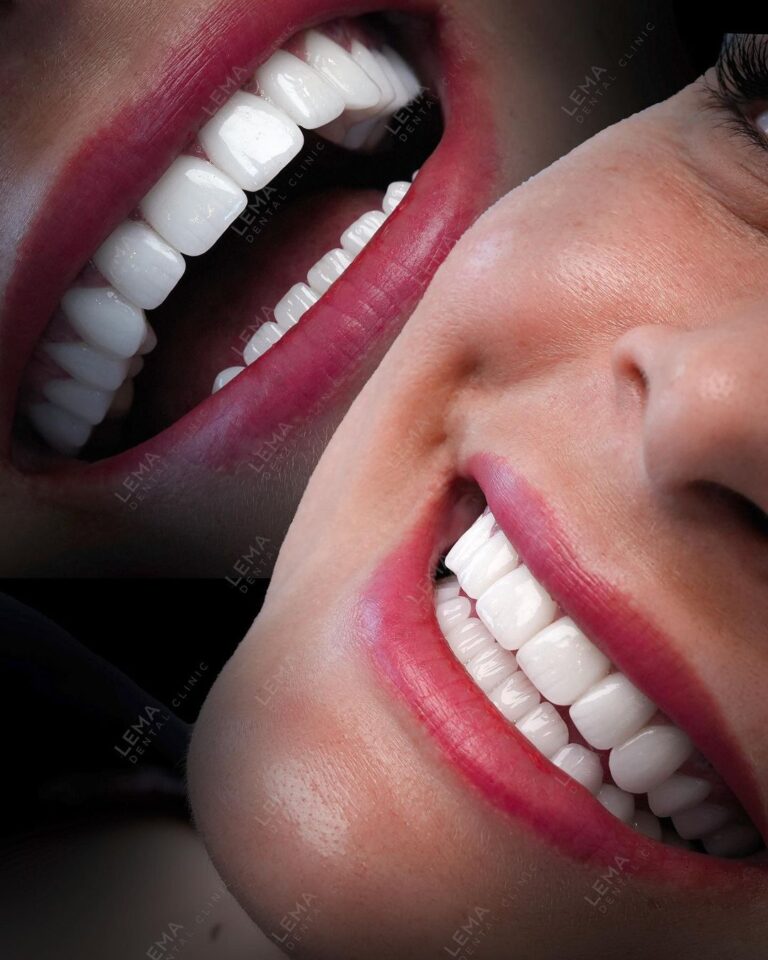 diş beyazlatma tedavisi