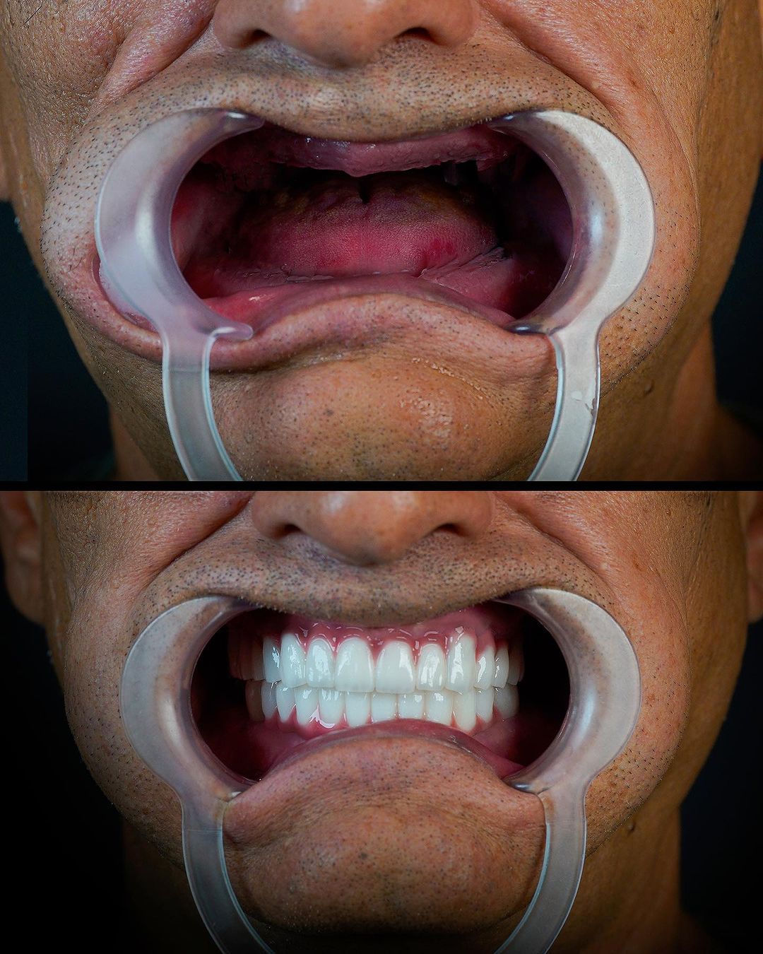 Diş implant sonrası