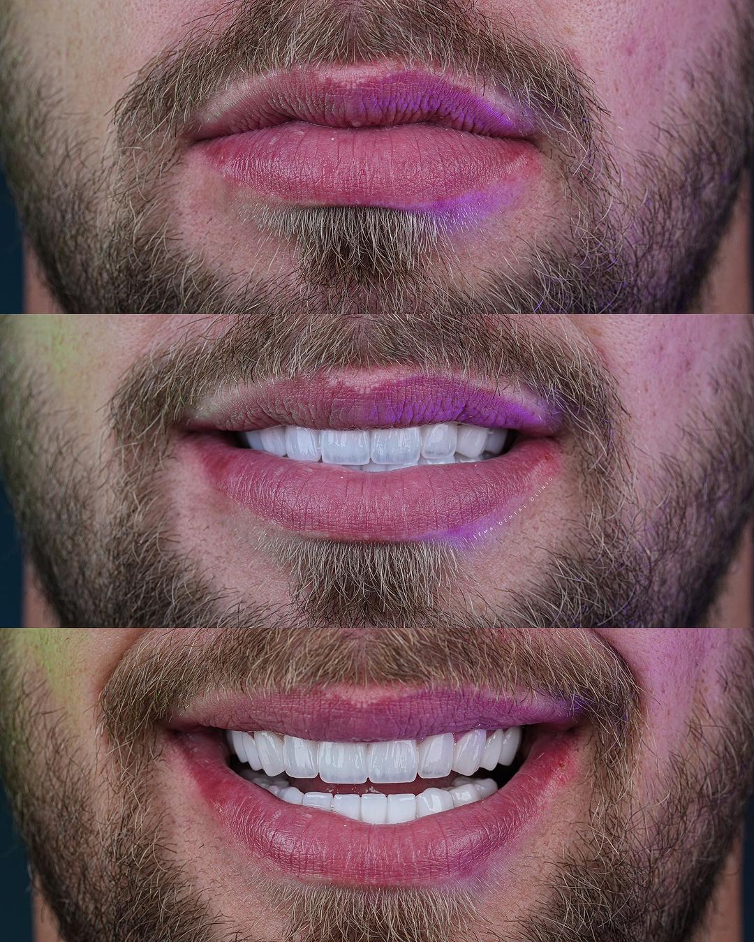 perfect teeth perfect smile