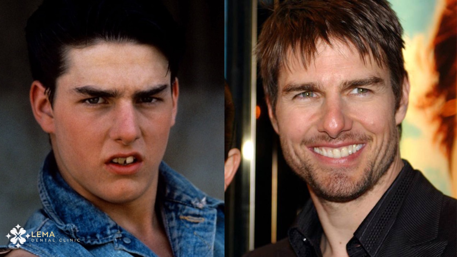 Tom Cruise teeth before