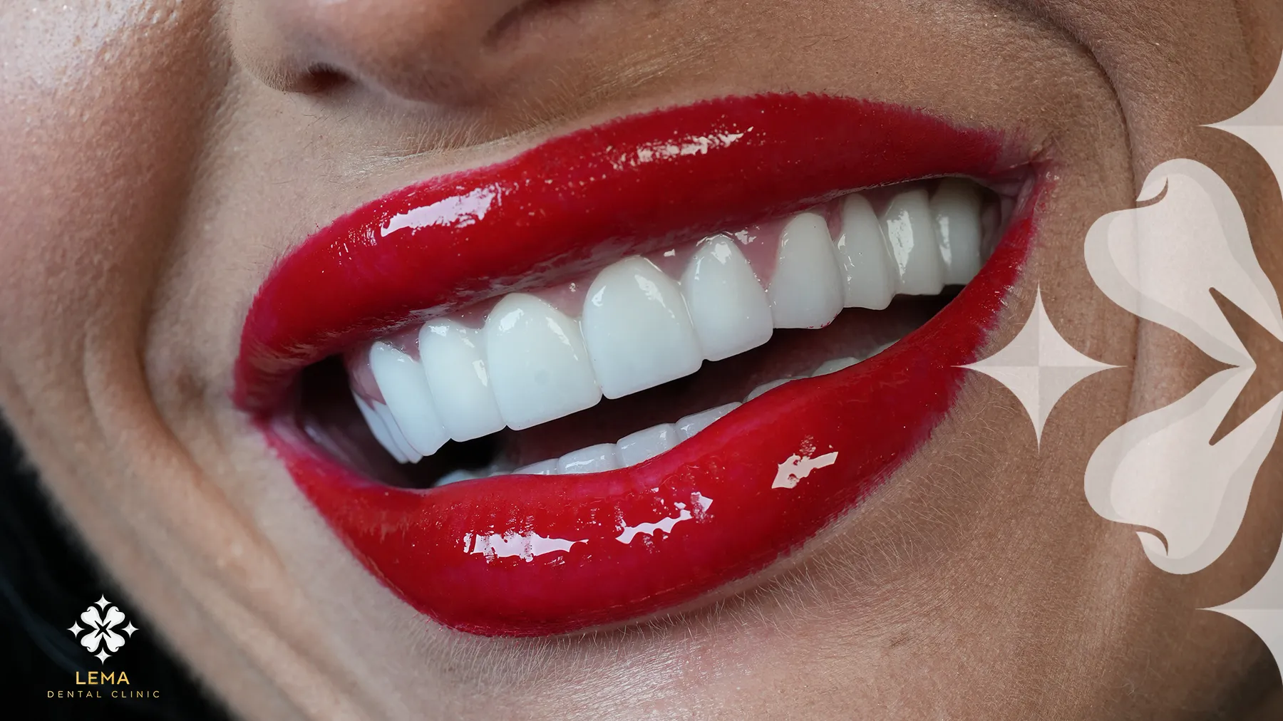 هل علاج تبييض الأسنان ضار؟