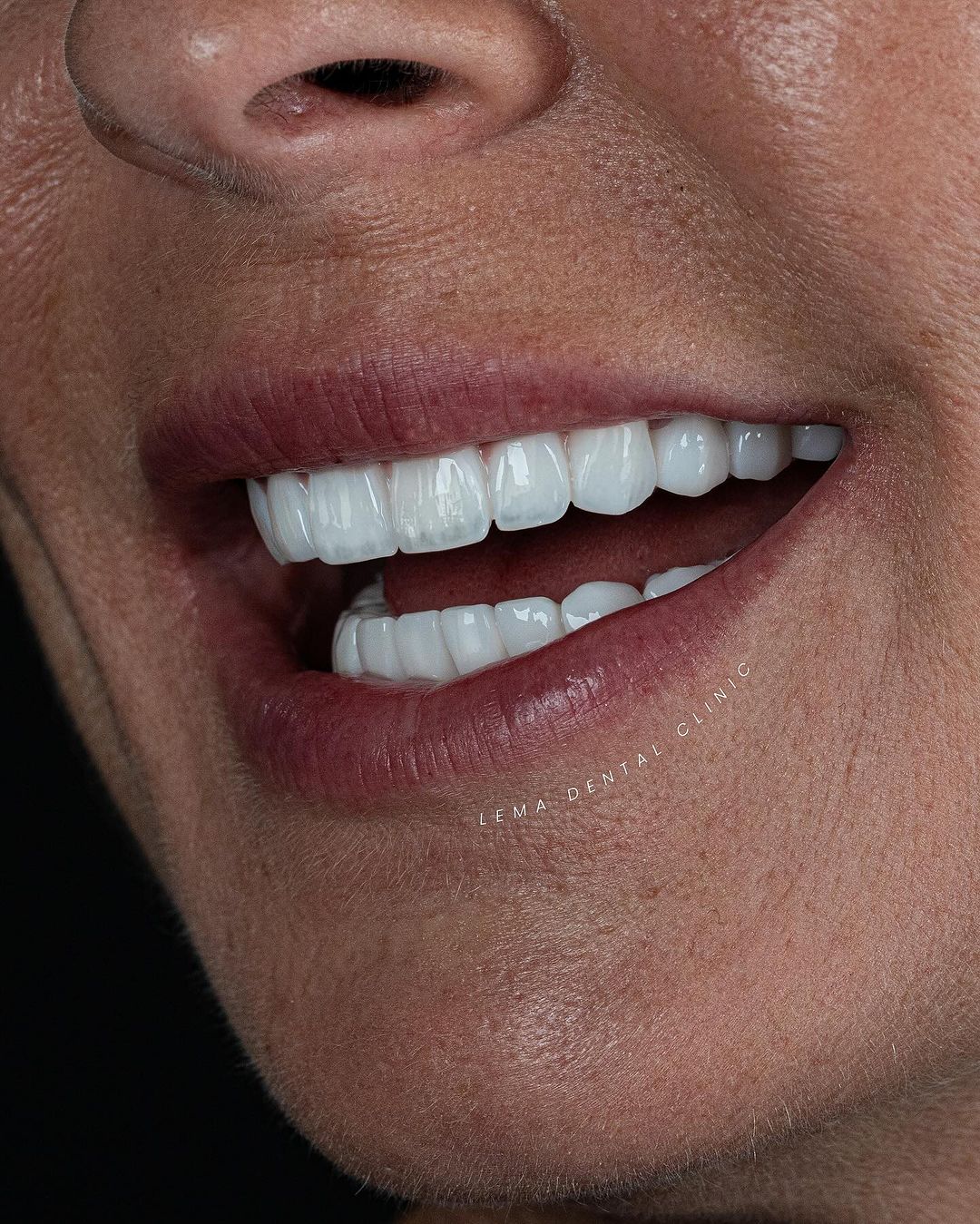 Dental Veneers Turkey Lema Dental Clinic 2024