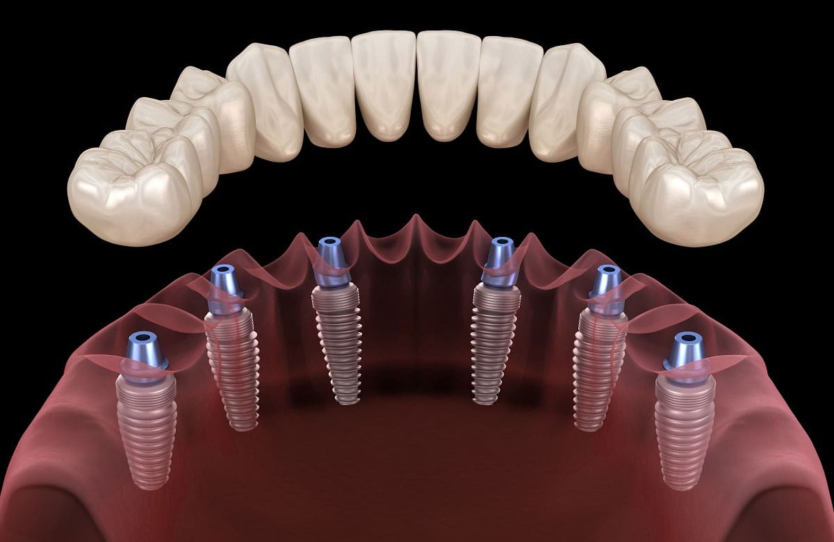 1-Gunde-Immediate-Implant1