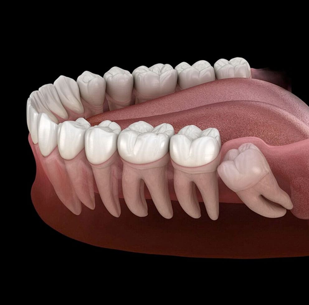 What To Eat After Wisdom Teeth Removal
