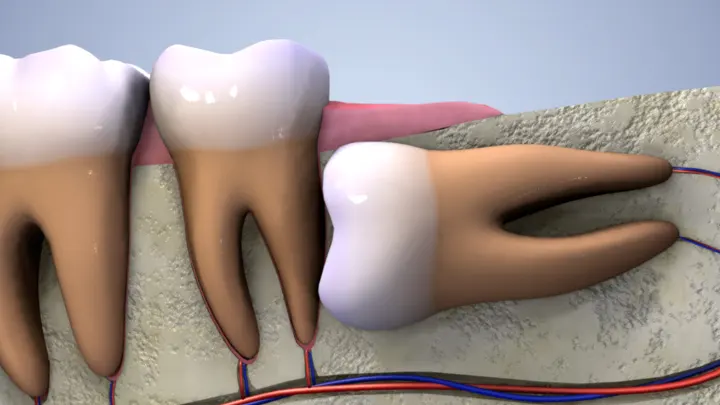 What Can I Eat After Wisdom Teeth Removal?