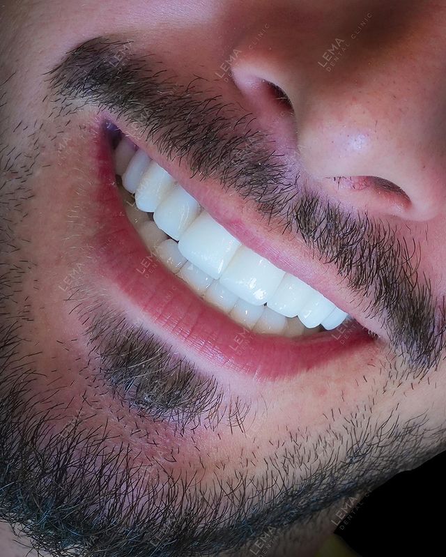 Dental İmplant Tedavisi