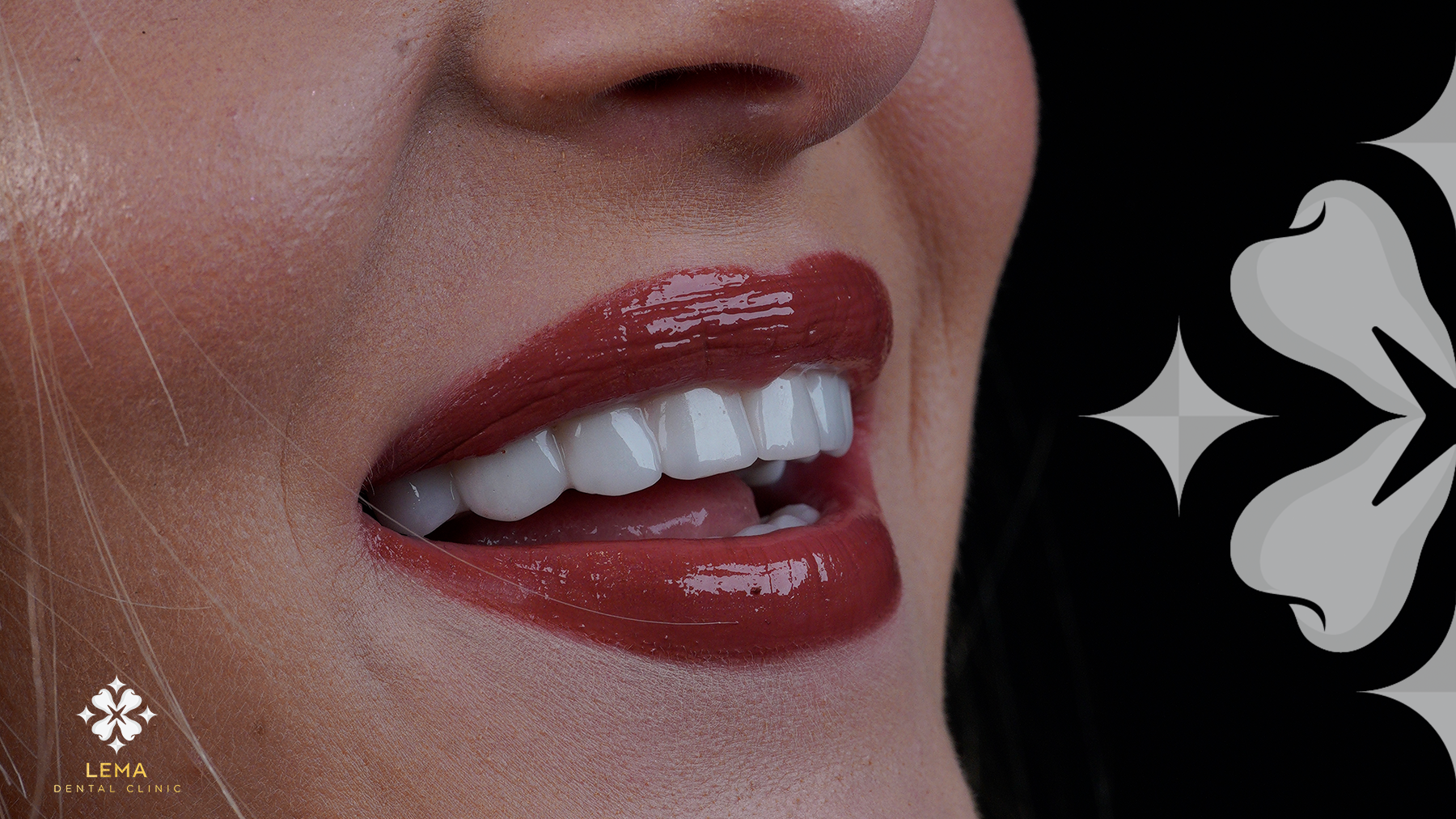Dental İmplant Tedavisi Nedir?