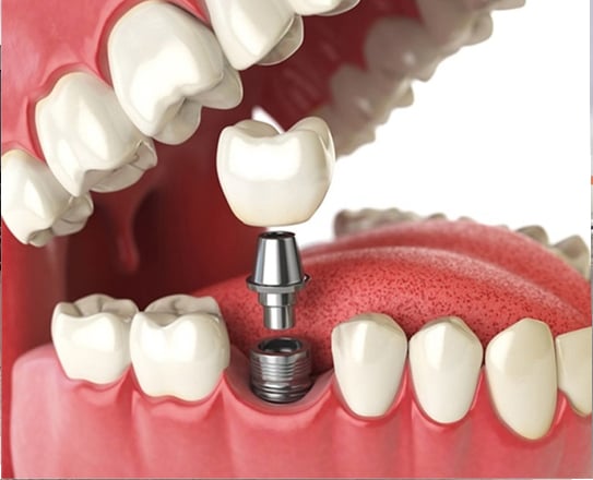 Cost Of Whole Mouth Implants