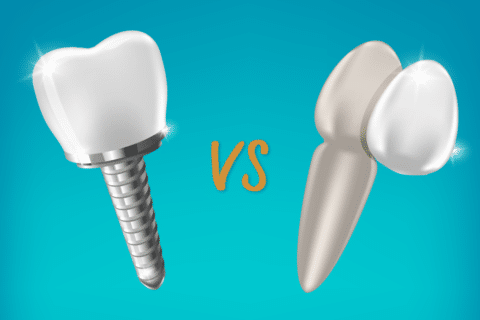 veneers vs dental implants