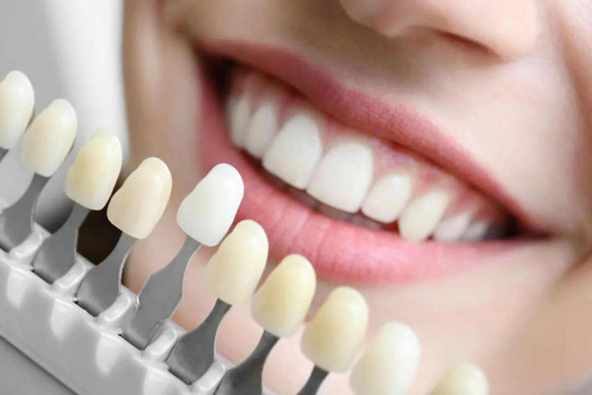 Emax Dental Veneers