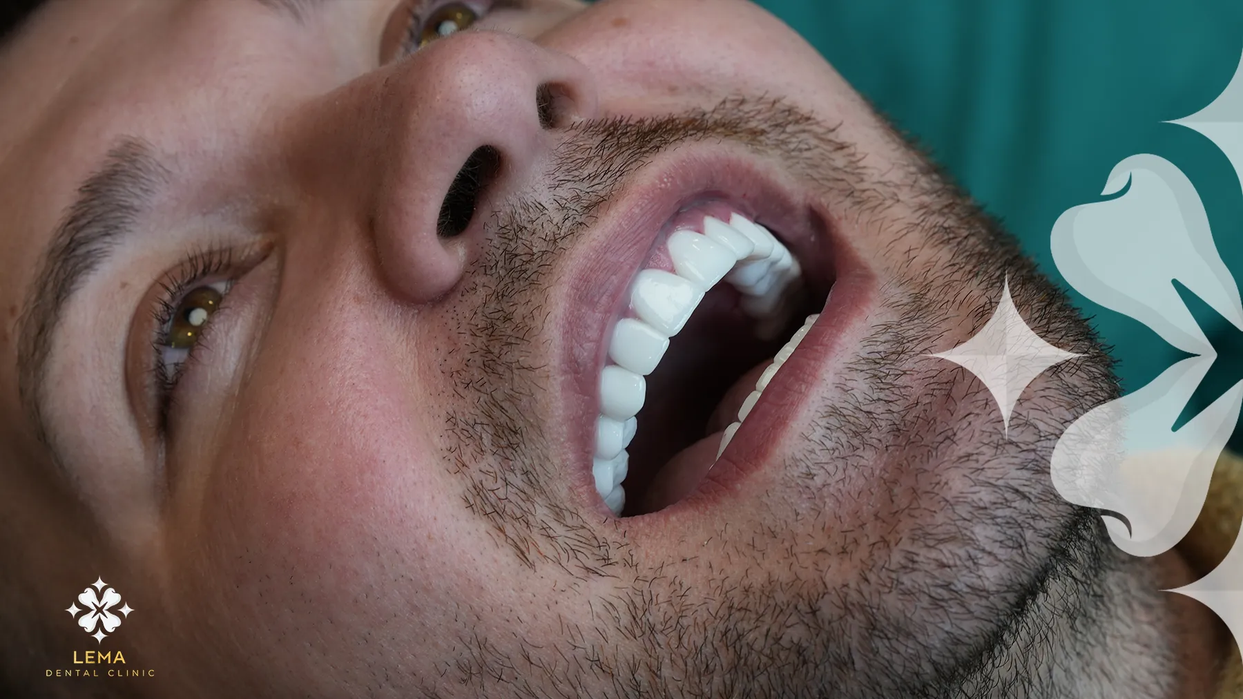 Emax Dental Veneers