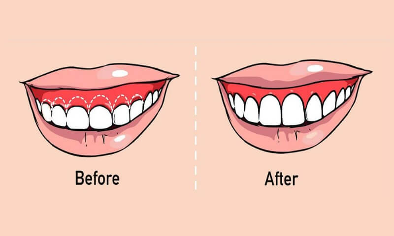 Gummy Smile Before And After