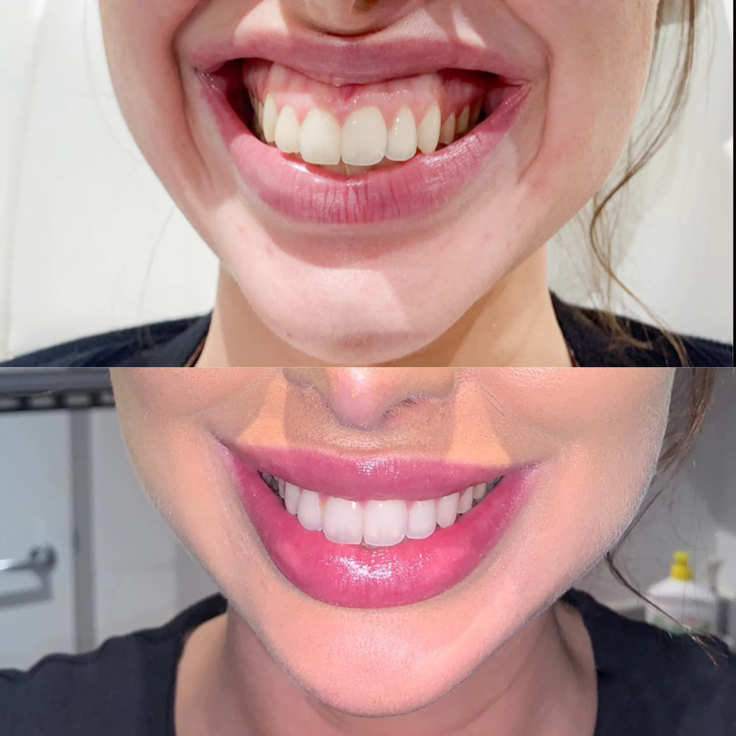 Gummy Smile Before And After