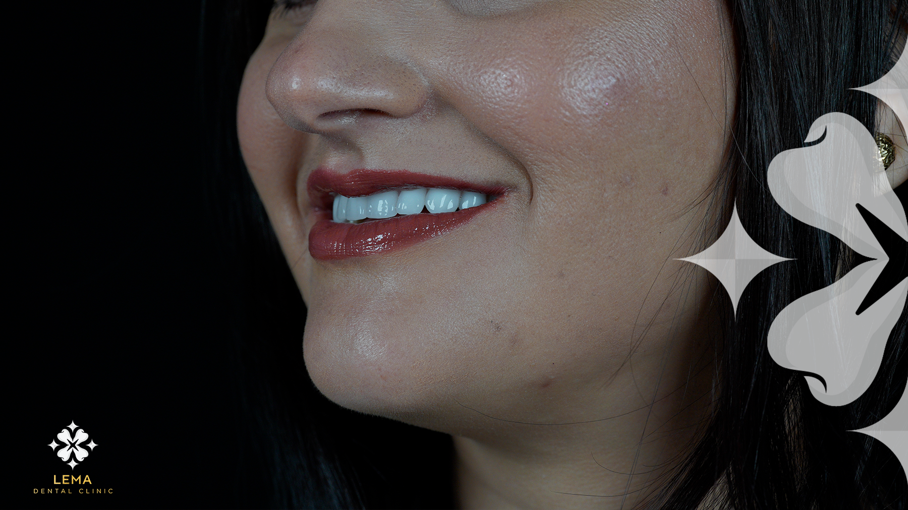 How Much Do Veneers Cost?