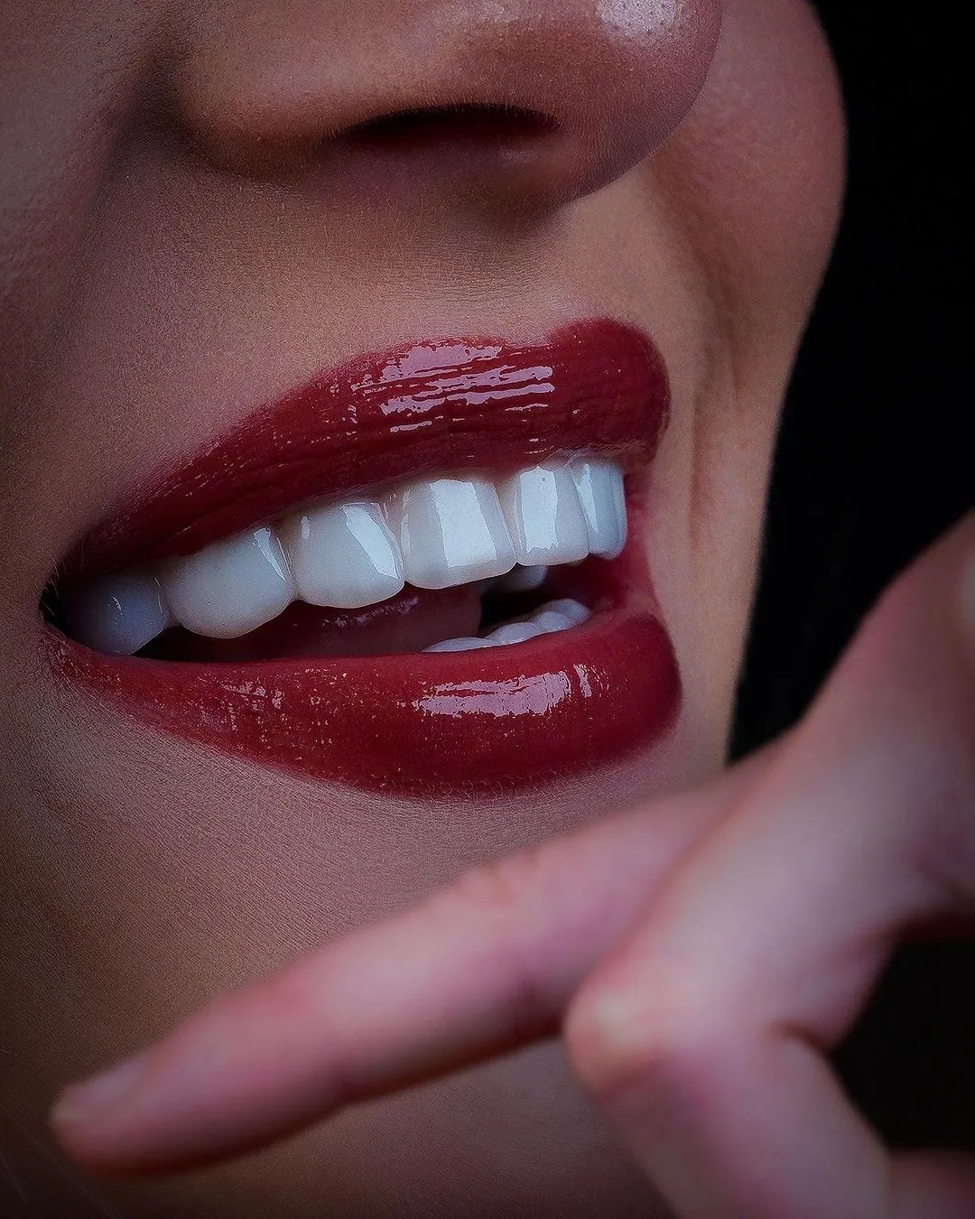 How Much Do Veneers Cost