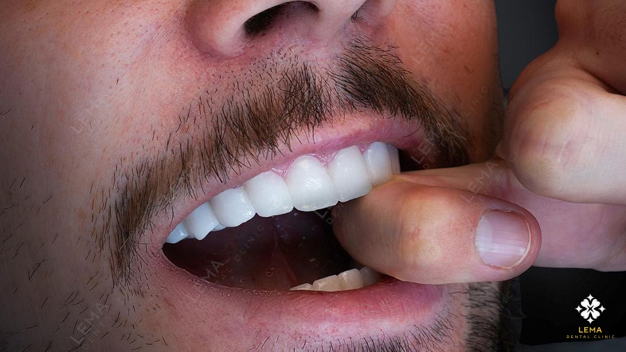 Dental Implant Surgery