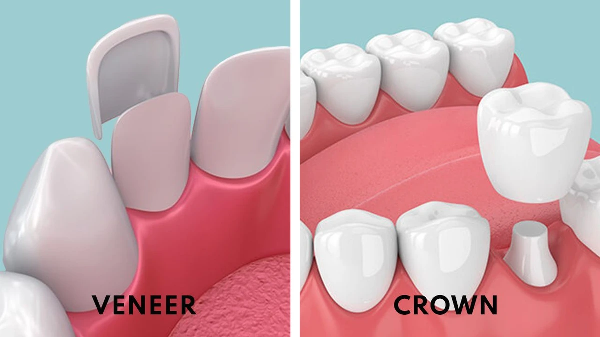 crowns vs veneers
