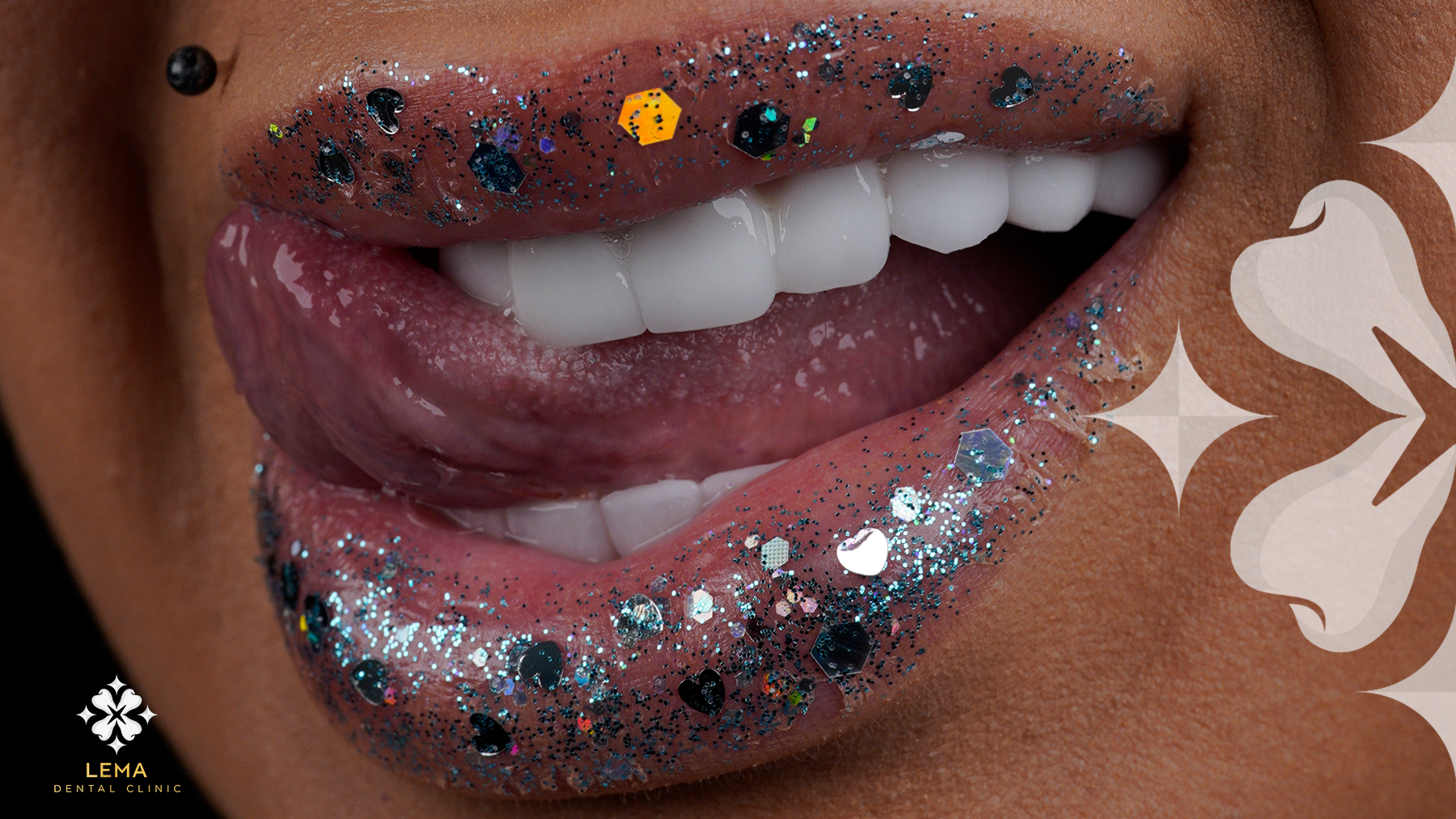 What Are The Dental Veneer Types