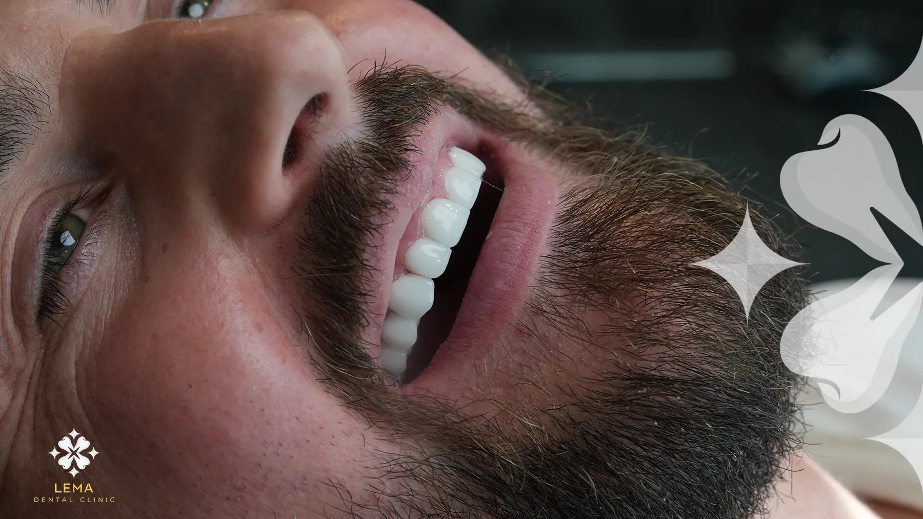 Tratament Cu İmplant Dentar în Turcia