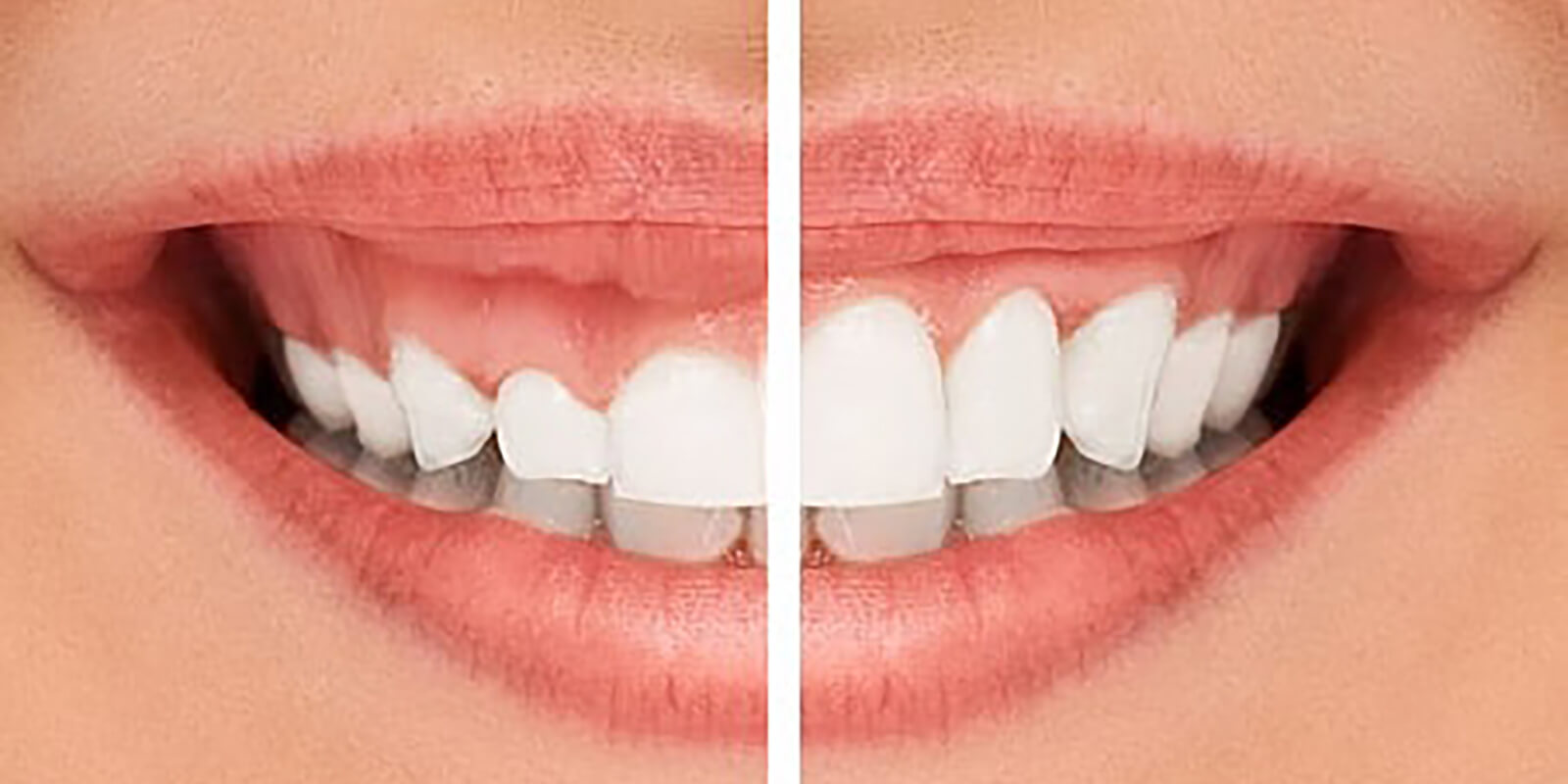 receding gums