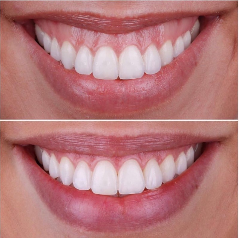 What Causes Receding Gums