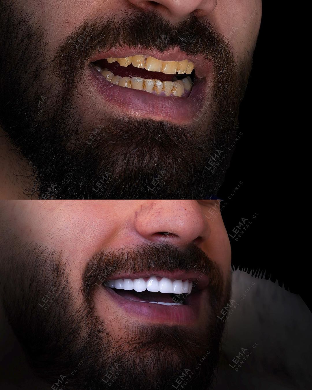 Hollywood Smile before and after