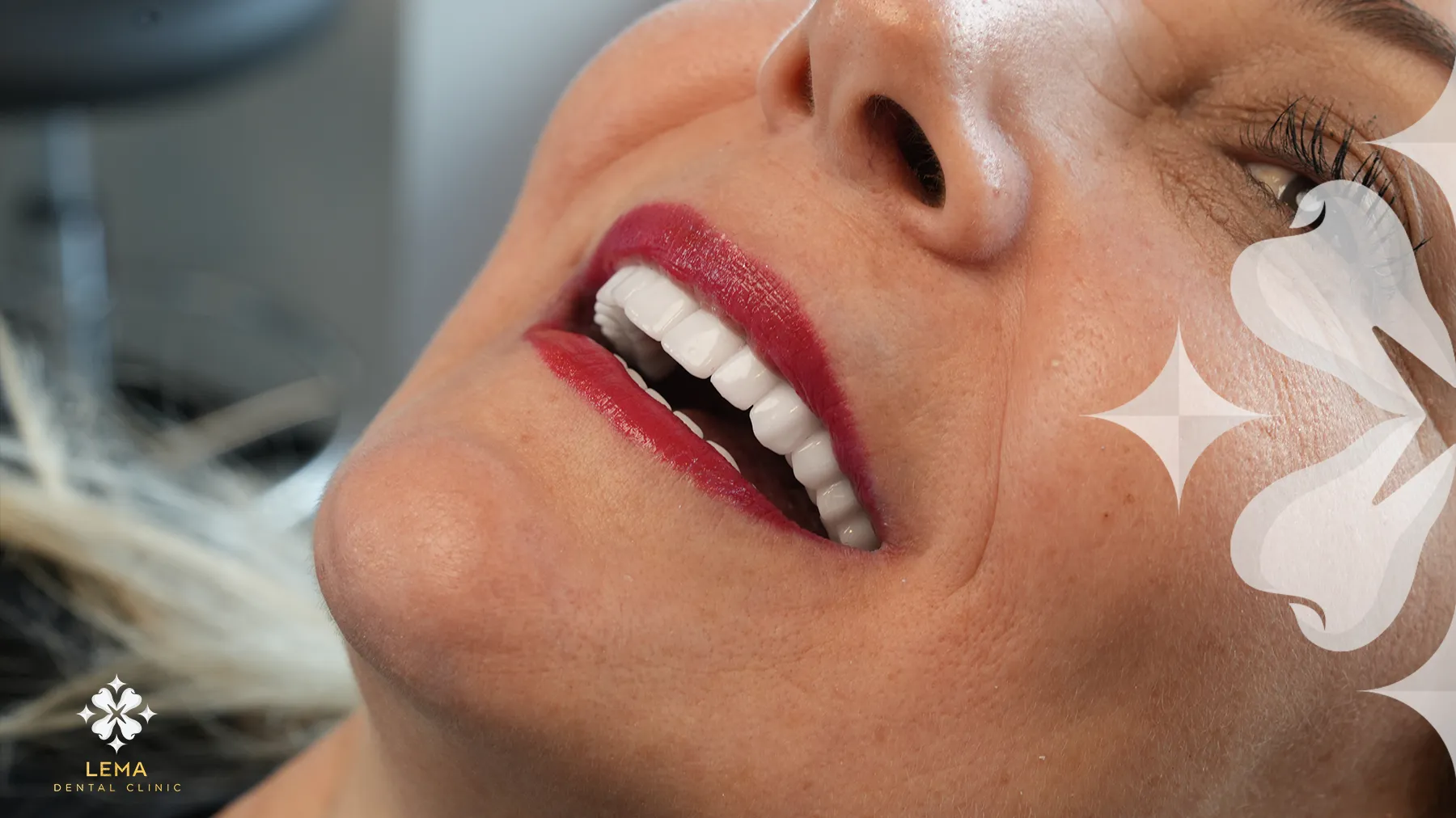 How Long Will My Veneers Last
