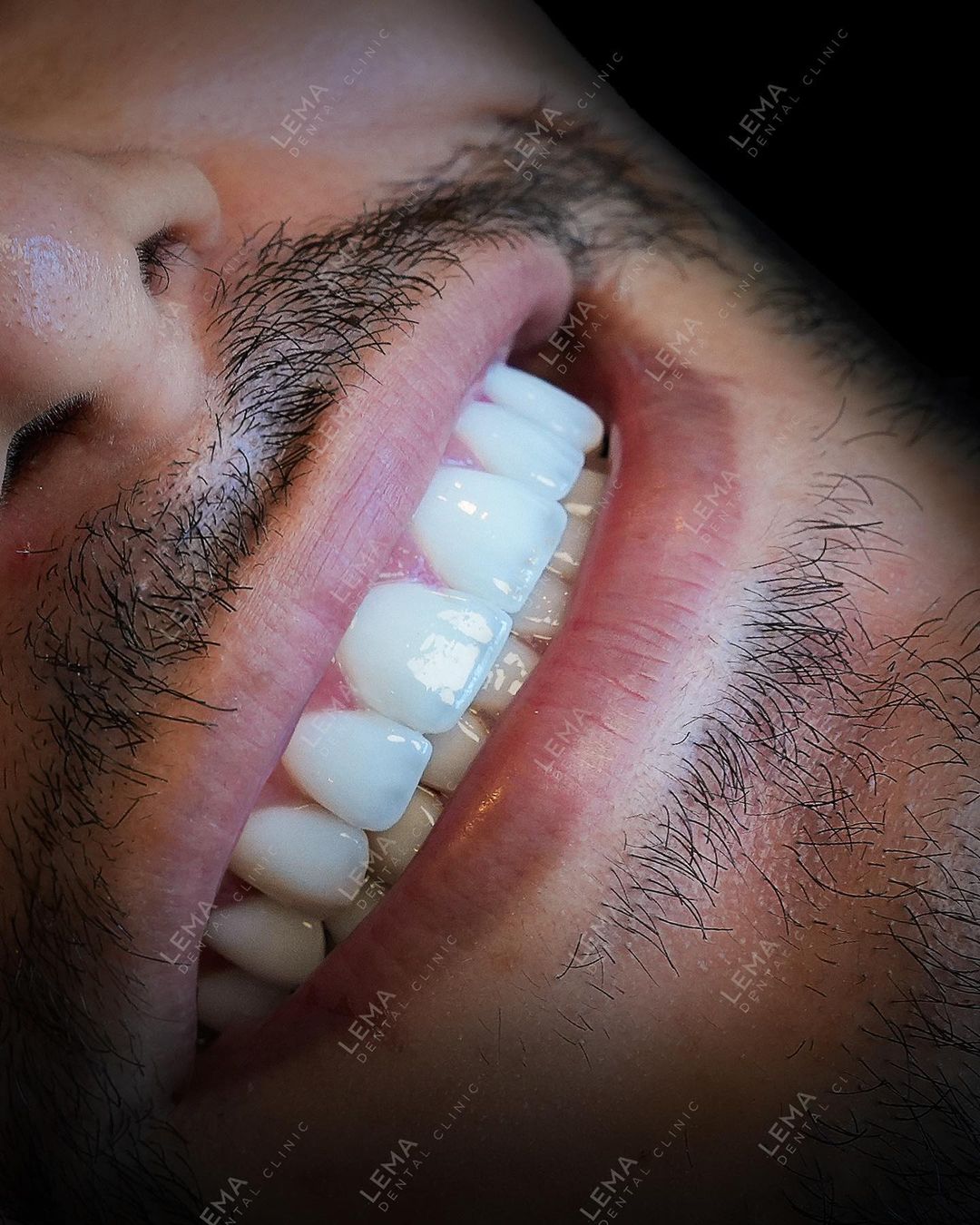 Teeth Whitening treatment Teeth Whitening treatment