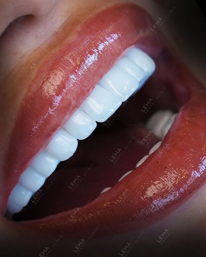 How Long Will My Veneers Last? 2024 Lema Dental Clinic