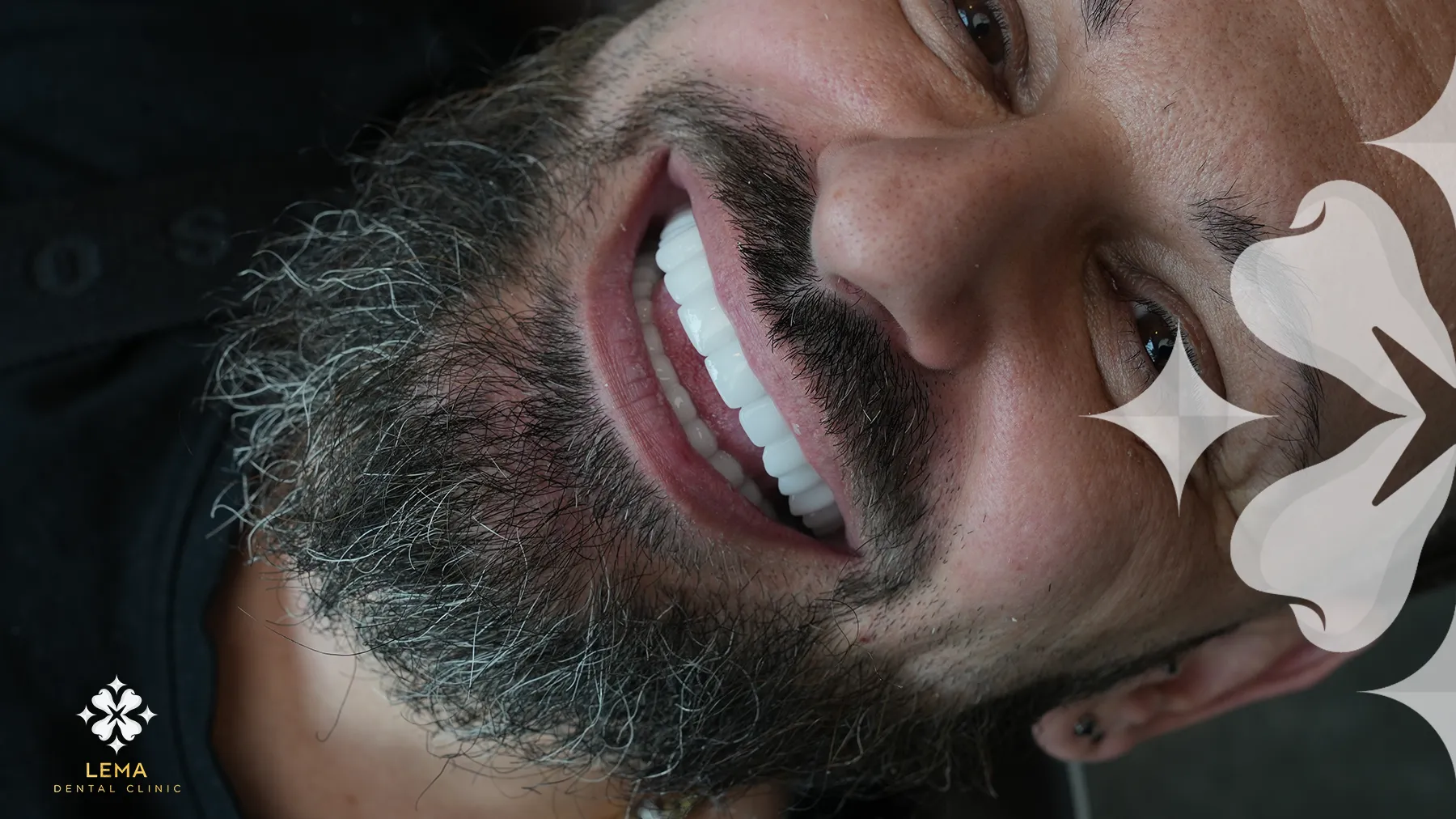 What Is The Diffrence Between Crowns And Veneers