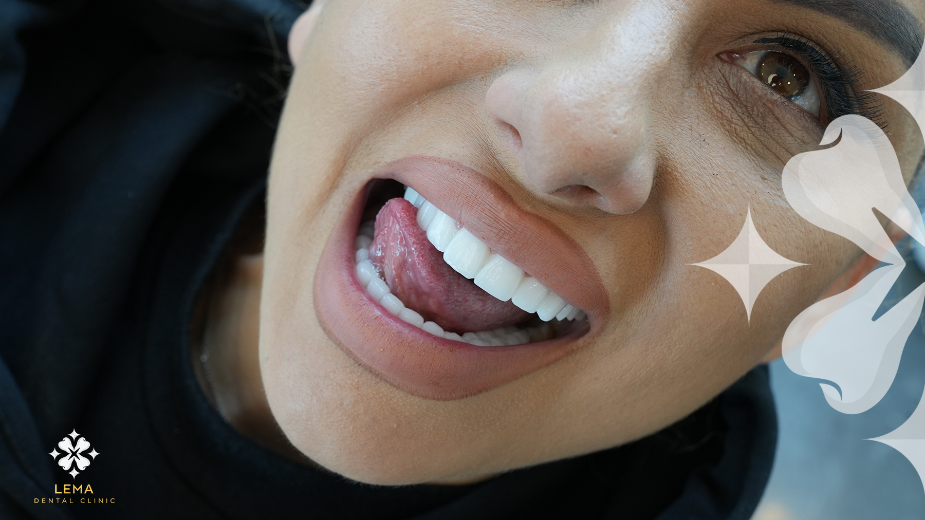 Când Pot Mânca După Un Implant Dentar