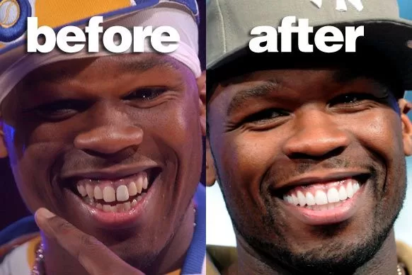 50 Cent Dişleri Öncesi ve Sonrası