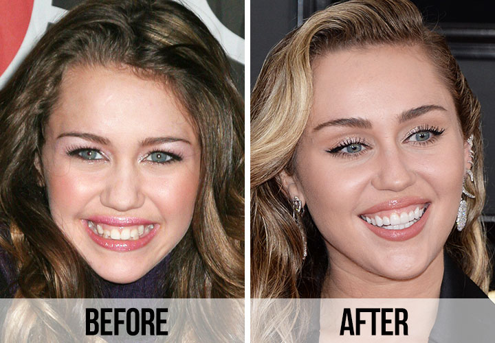 Miley Cyrus' Smile Before and After