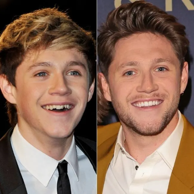 Niall Horans Zähne: Vorher und Nachher