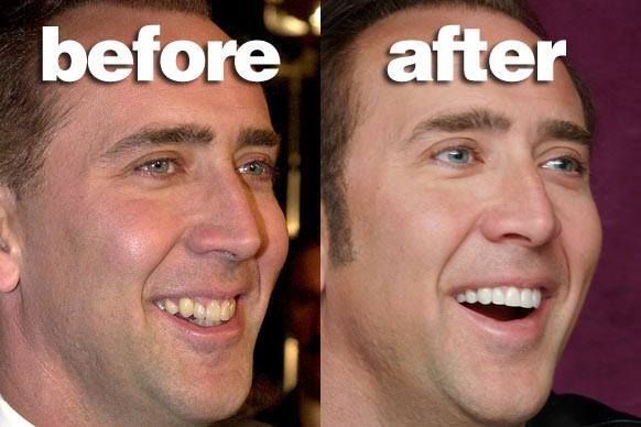 Nicolas Cage’s Teeth Makeover Before & After